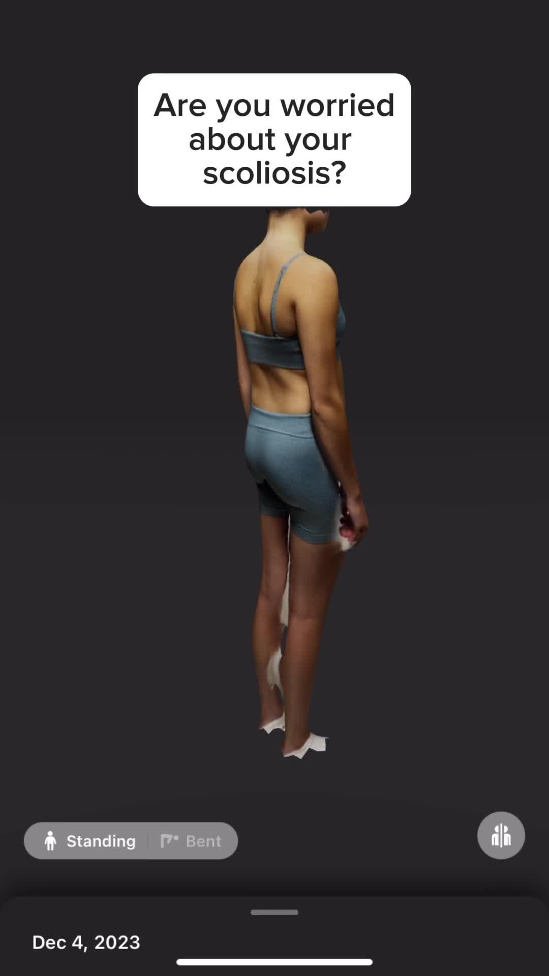 Momentum Spine can help you keep track of your scoliosis from home! Download now on the App Store and on the Google Play Store! ✨ #fyp #app #newapp #remote #scoliosis #ai 