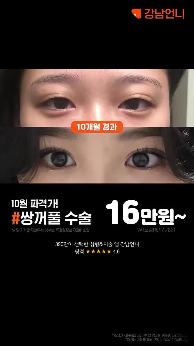 와 쌍수 진짜 잘됐다ㄷㄷ