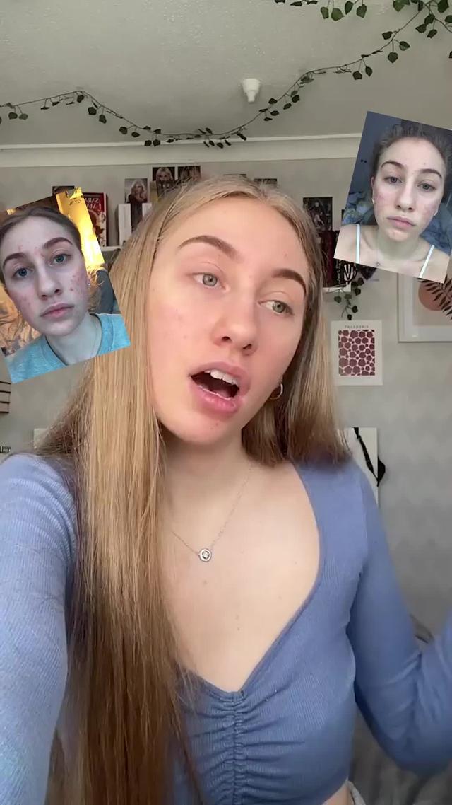 acne to clear skin ✨ #acnefighter