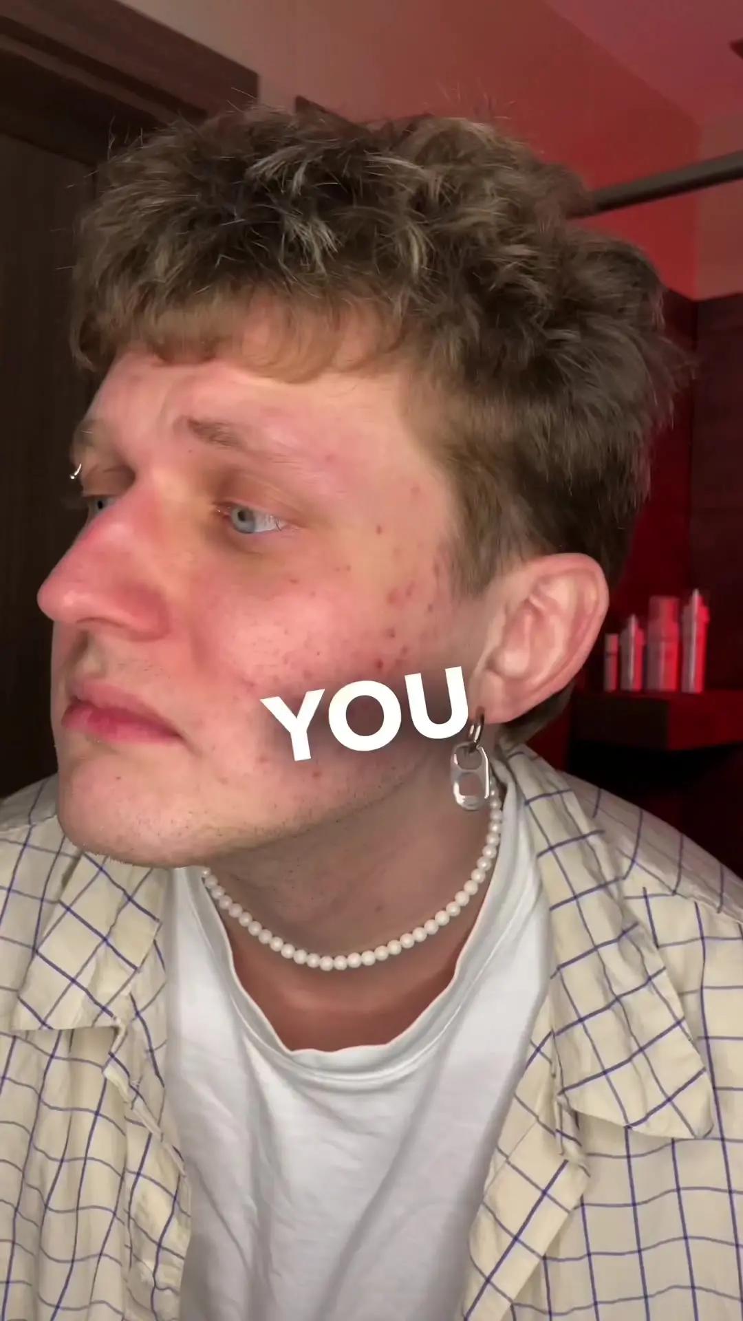 Don’t cry because of pimples 🫶🏽 Try our free app that supports you on your skin journey 💙